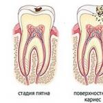 Zubný kaz mliečnych zubov u detí: čo robiť, ako liečiť Liečba kazu mliečnych zubov u detí